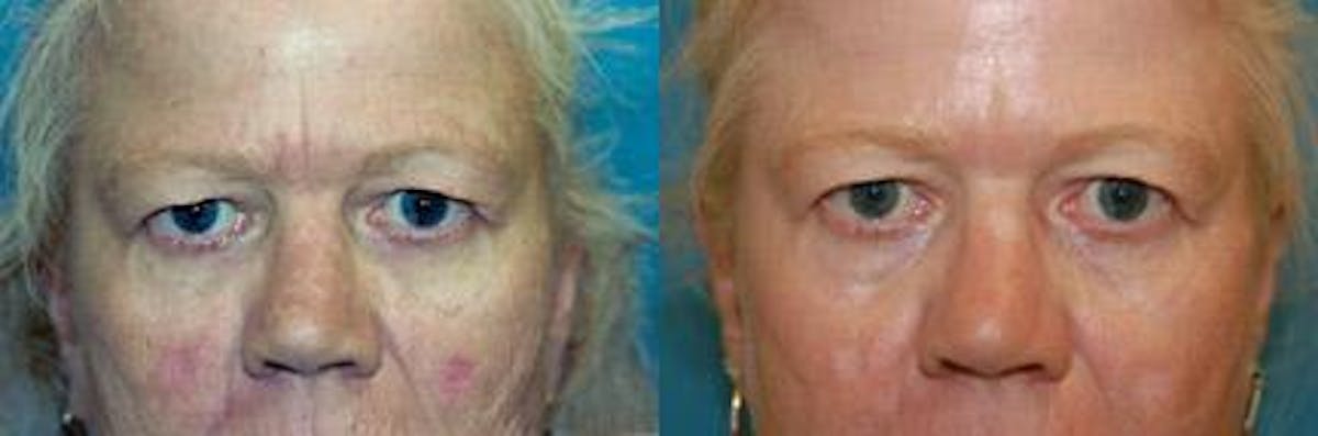 Skin Resurfacing Before & After Gallery - Patient 122406729 - Image 3