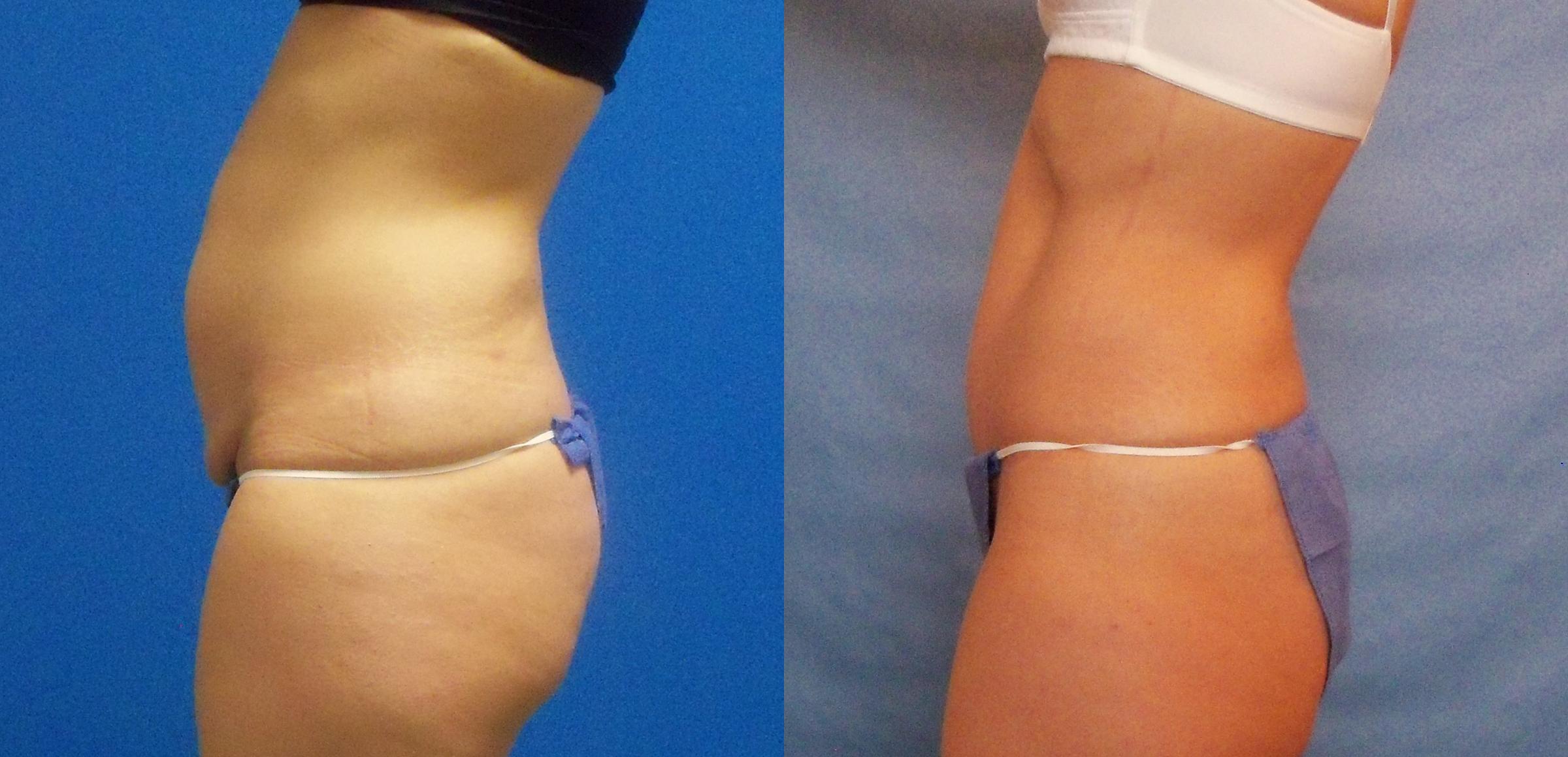 Hidden Tummy Tuck Before & After Gallery - Patient 288122 - Image 3