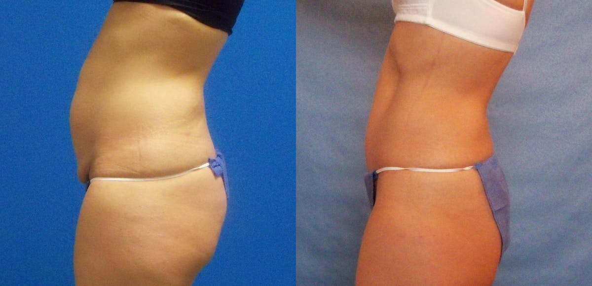 Tummy Tuck Before & After Gallery - Patient 467536 - Image 3
