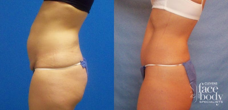 Hidden Tummy Tuck Before & After Gallery - Patient 288122 - Image 3