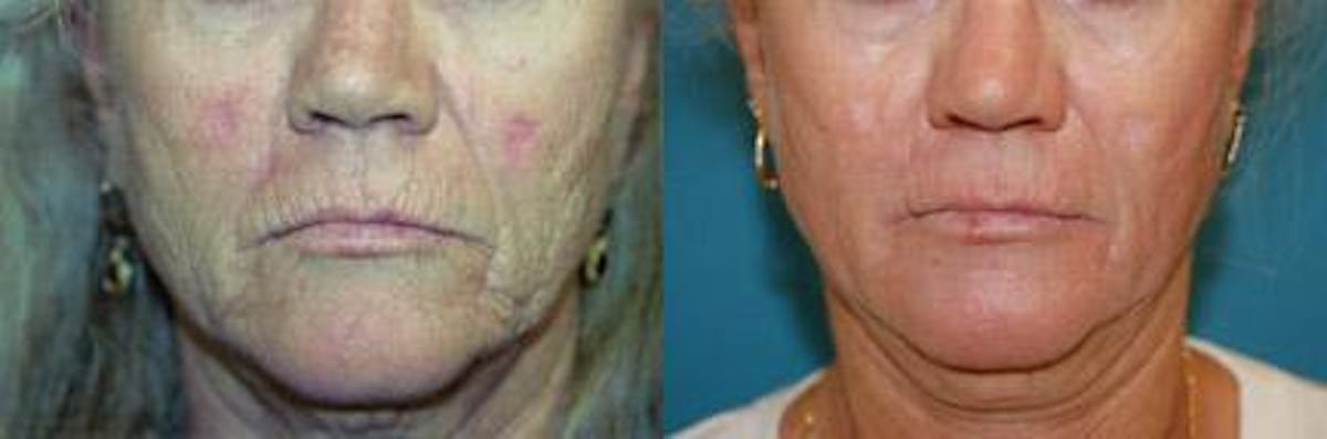 Skin Resurfacing Before & After Gallery - Patient 122406729 - Image 4