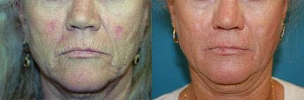 Skin Resurfacing Before & After Gallery - Patient 122406729 - Image 4