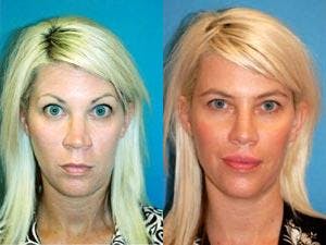 Rhinoplasty Before & After Gallery - Patient 122406732 - Image 1