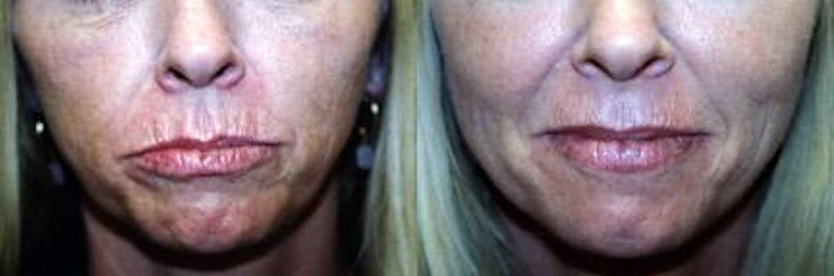 Skin Resurfacing Before & After Gallery - Patient 122406731 - Image 1