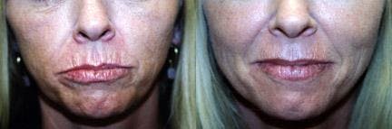 Skin Resurfacing Before & After Gallery - Patient 122406731 - Image 1