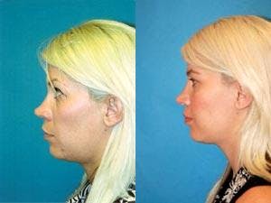 Rhinoplasty Before & After Gallery - Patient 122406732 - Image 2