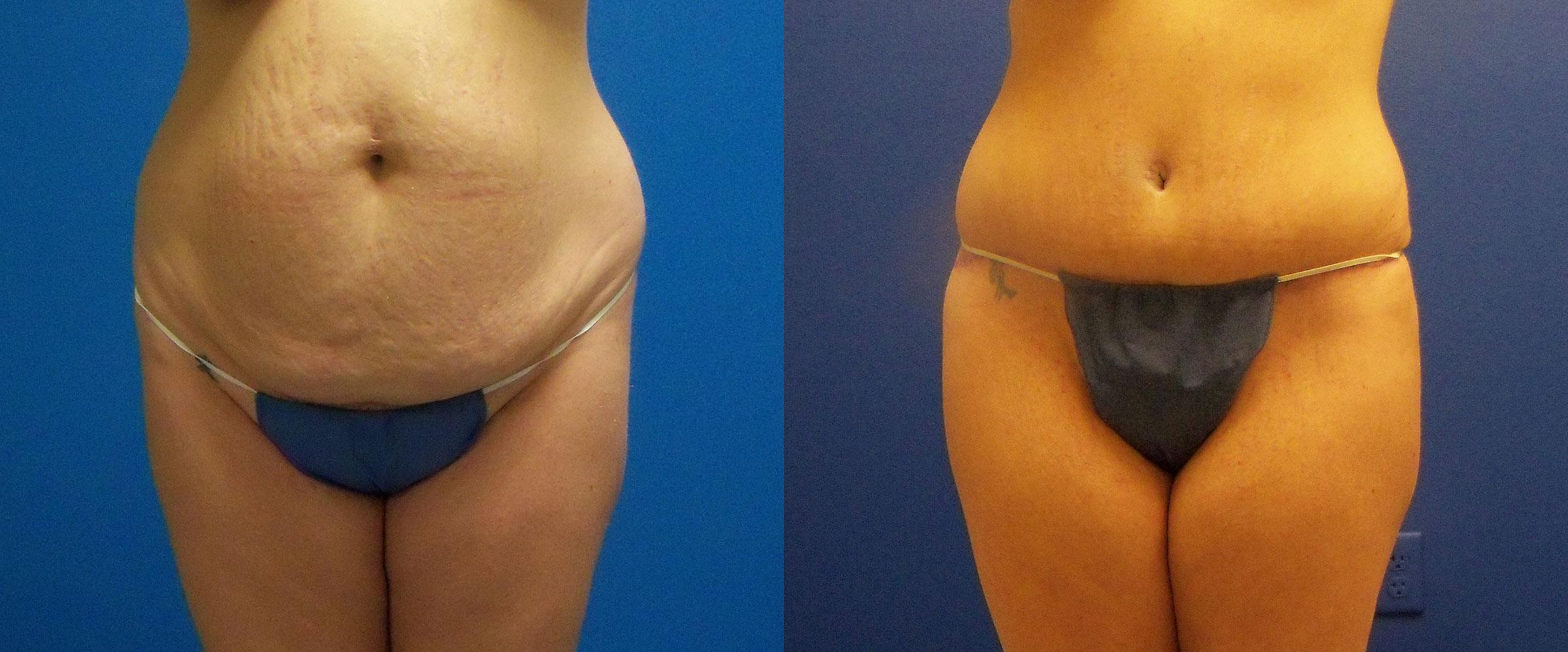 Hidden Tummy Tuck Before & After Gallery - Patient 330643 - Image 1