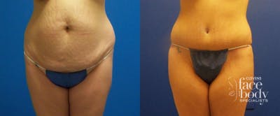 Hidden Tummy Tuck Before & After Gallery - Patient 330643 - Image 1