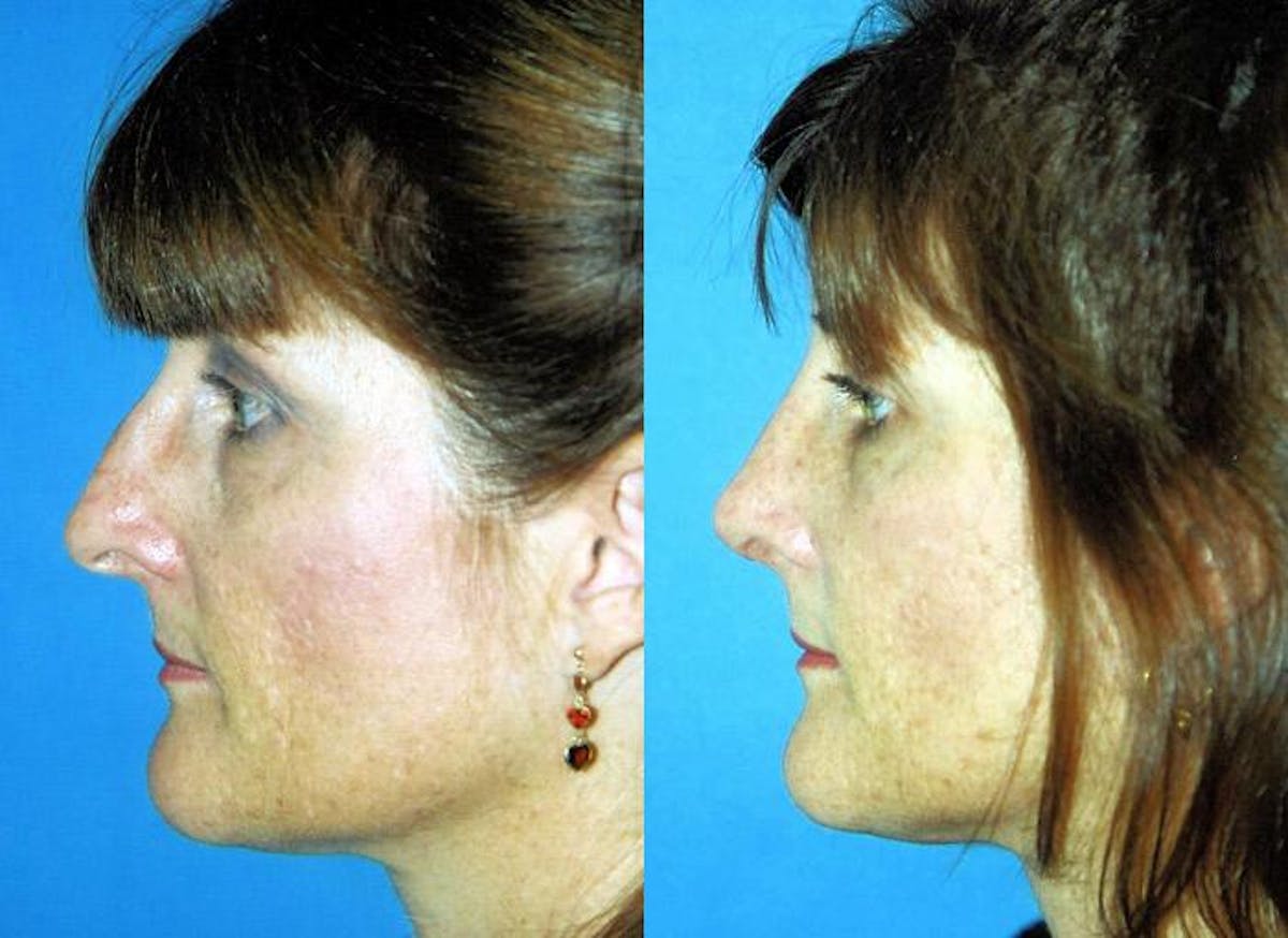 Rhinoplasty Before & After Gallery - Patient 122406734 - Image 1