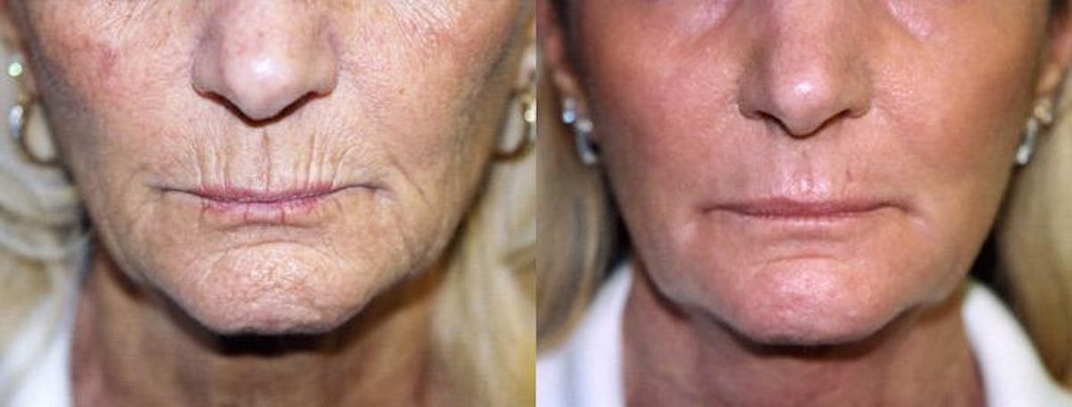 Skin Resurfacing Before & After Gallery - Patient 122406733 - Image 1