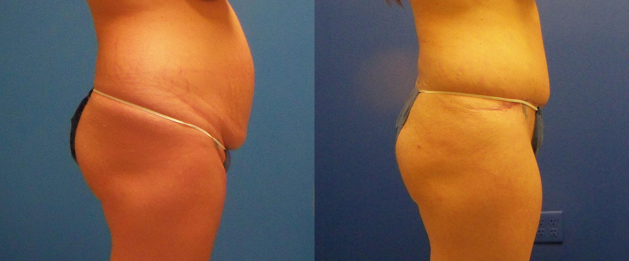 Hidden Tummy Tuck Before & After Gallery - Patient 330643 - Image 2
