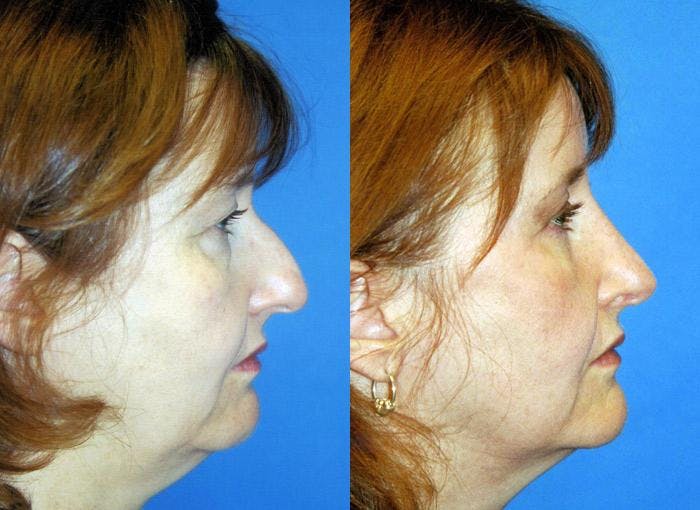 Rhinoplasty Before & After Gallery - Patient 122406736 - Image 1