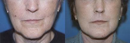 Skin Resurfacing Before & After Gallery - Patient 122406735 - Image 1