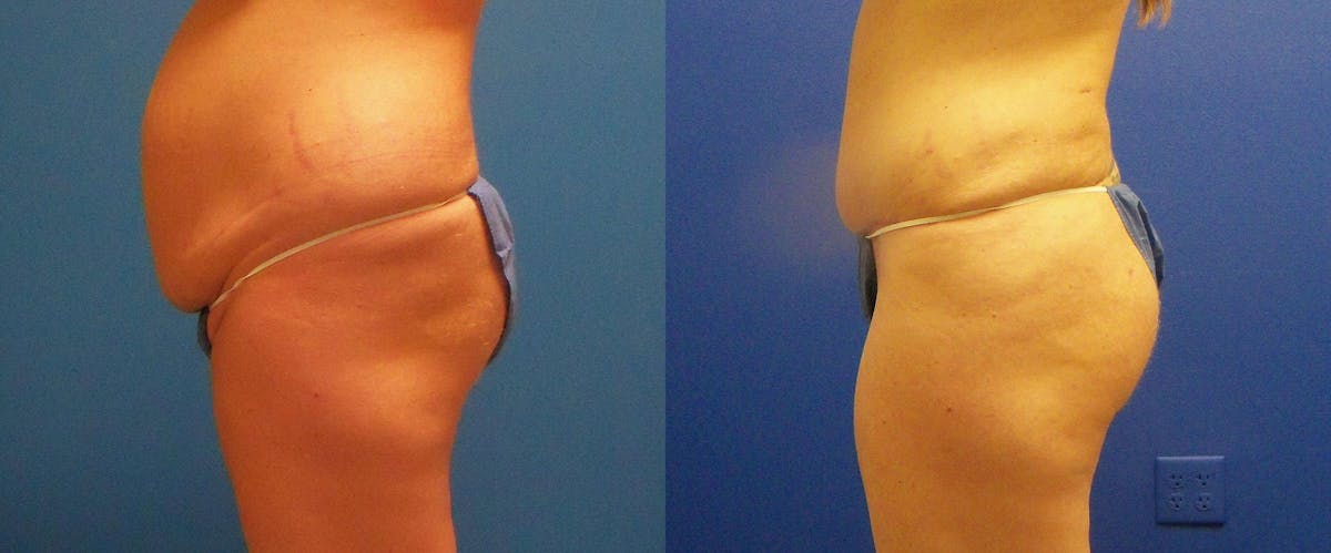 Hidden Tummy Tuck Before & After Gallery - Patient 330643 - Image 3