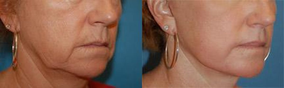 Skin Resurfacing Before & After Gallery - Patient 122406738 - Image 1
