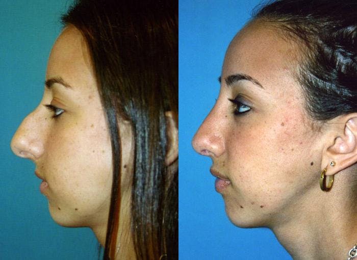 Rhinoplasty Before & After Gallery - Patient 122406737 - Image 1