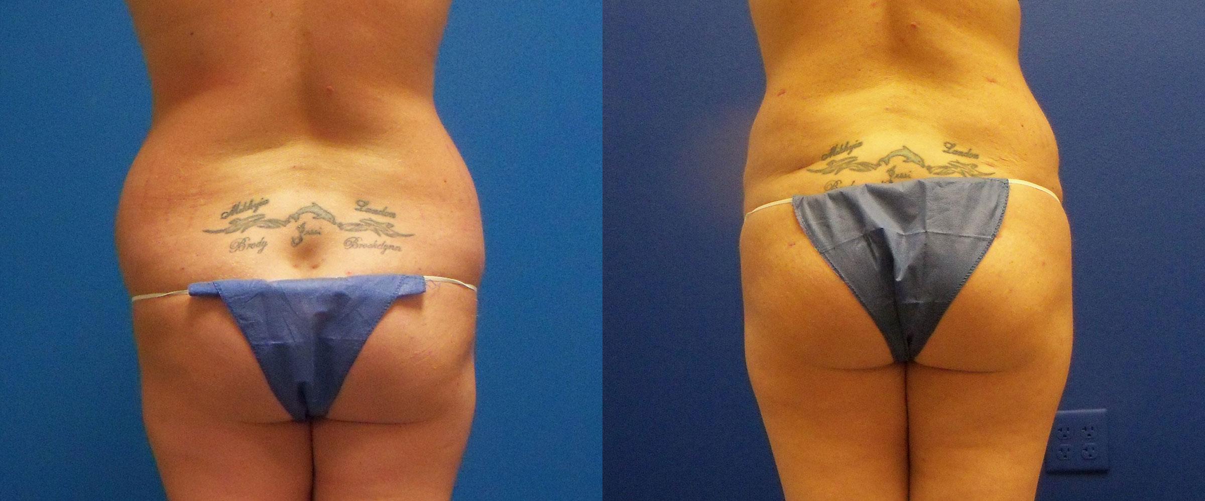 Hidden Tummy Tuck Before & After Gallery - Patient 330643 - Image 4