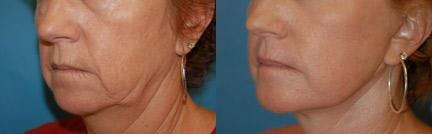 Skin Resurfacing Before & After Gallery - Patient 122406738 - Image 2