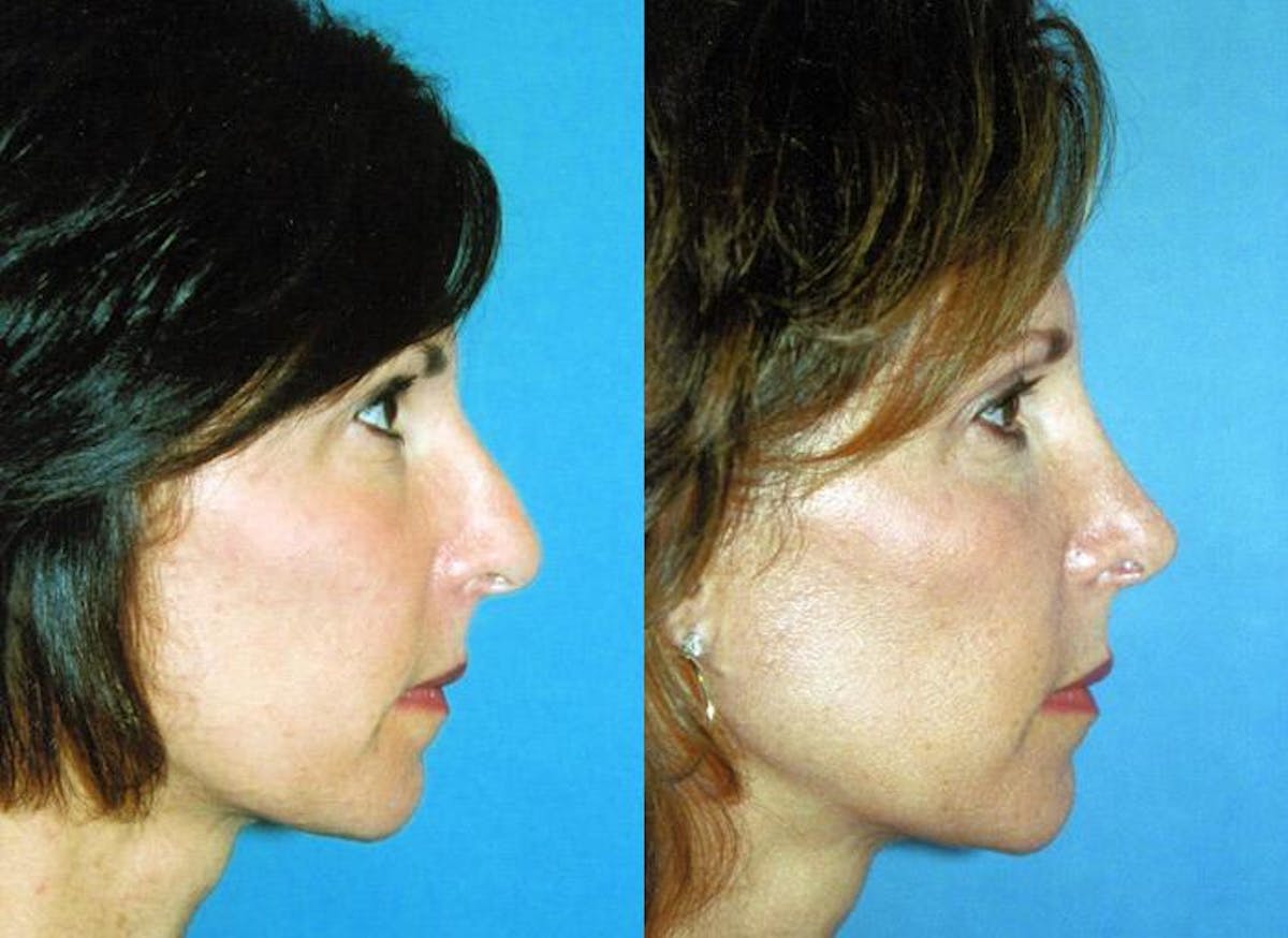 Rhinoplasty Before & After Gallery - Patient 122406741 - Image 1