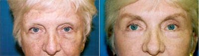 Skin Resurfacing Before & After Gallery - Patient 122406740 - Image 1