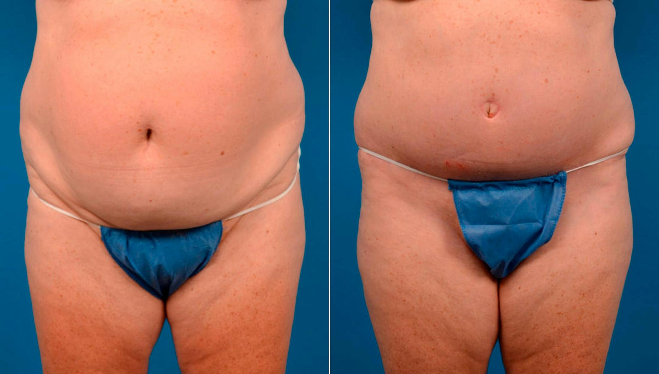Tummy Tuck Before & After Gallery - Patient 122406742 - Image 1