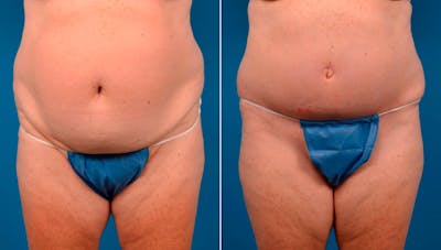 Tummy Tuck Before & After Gallery - Patient 160486 - Image 1
