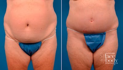 Hidden Tummy Tuck Before & After Gallery - Patient 394859 - Image 1