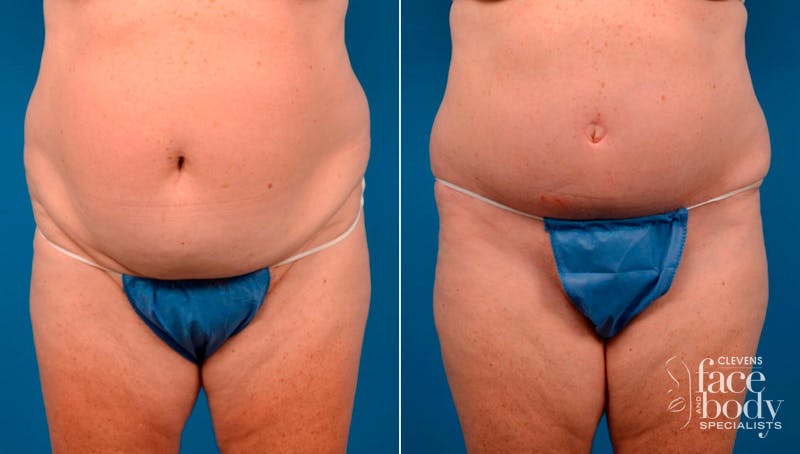 Hidden Tummy Tuck Before & After Gallery - Patient 394859 - Image 1