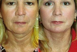 Skin Resurfacing Before & After Gallery - Patient 122406745 - Image 1