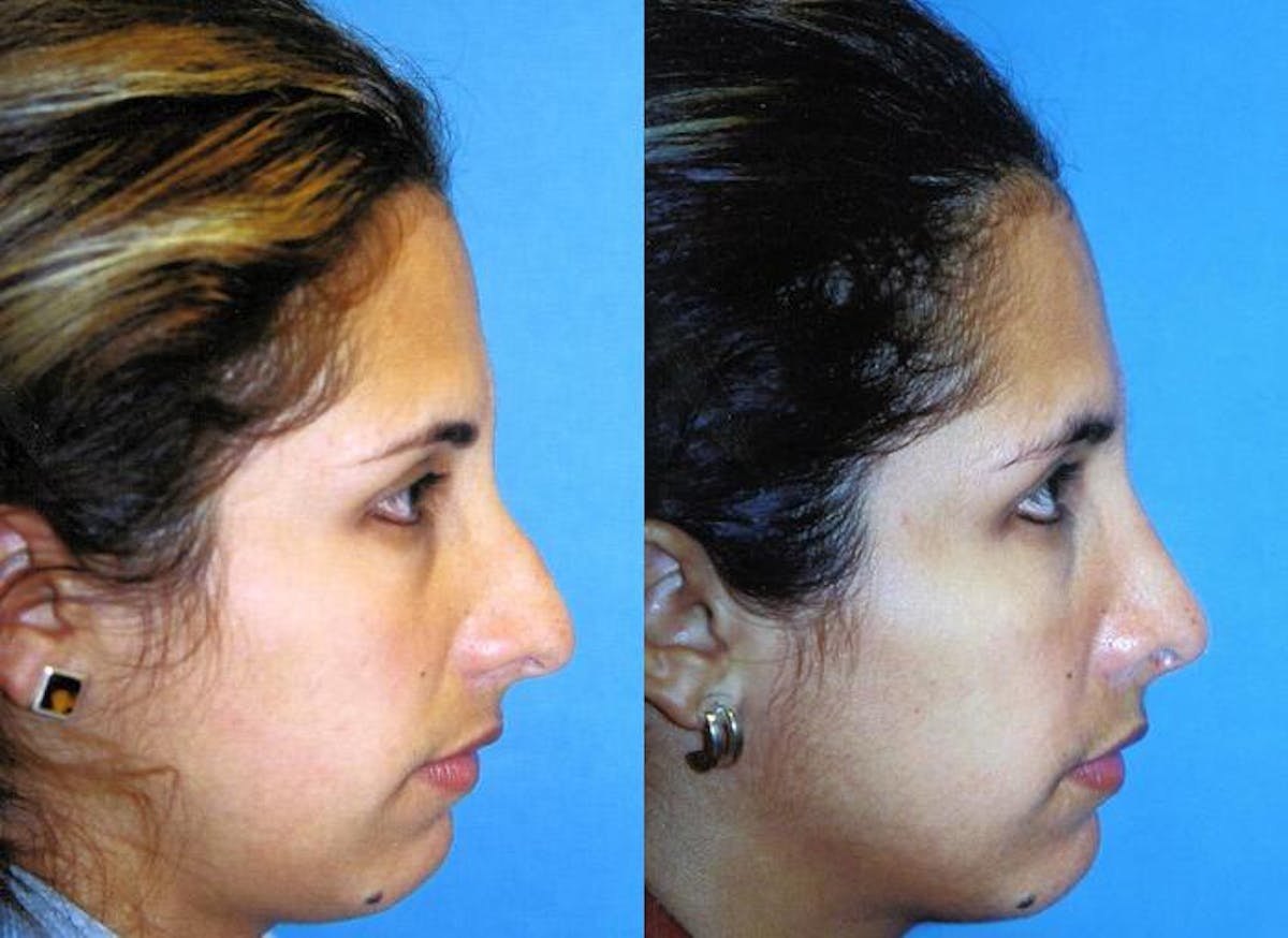 Rhinoplasty Before & After Gallery - Patient 122406743 - Image 1