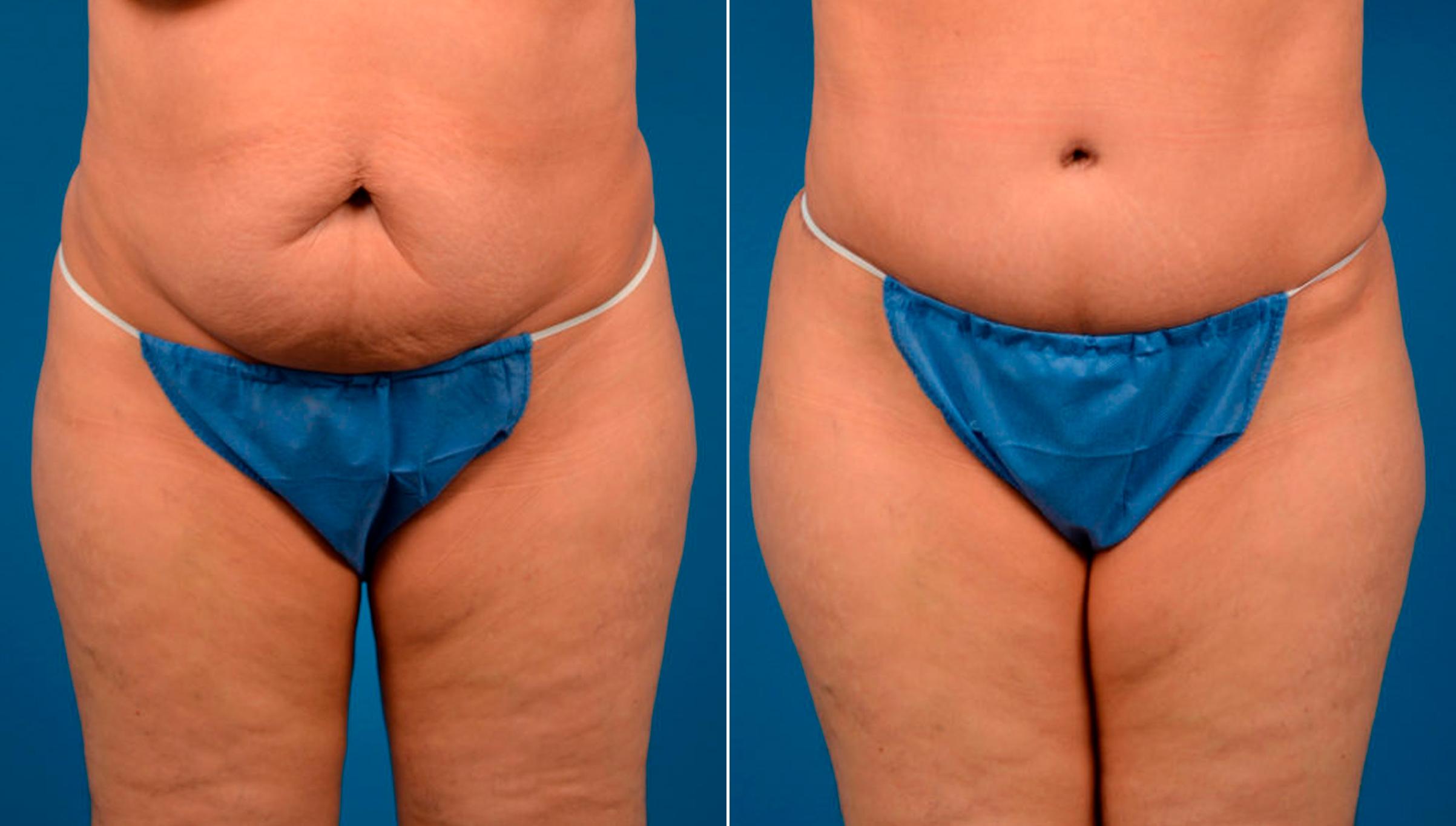 Hidden Tummy Tuck Before & After Gallery - Patient 124954 - Image 1