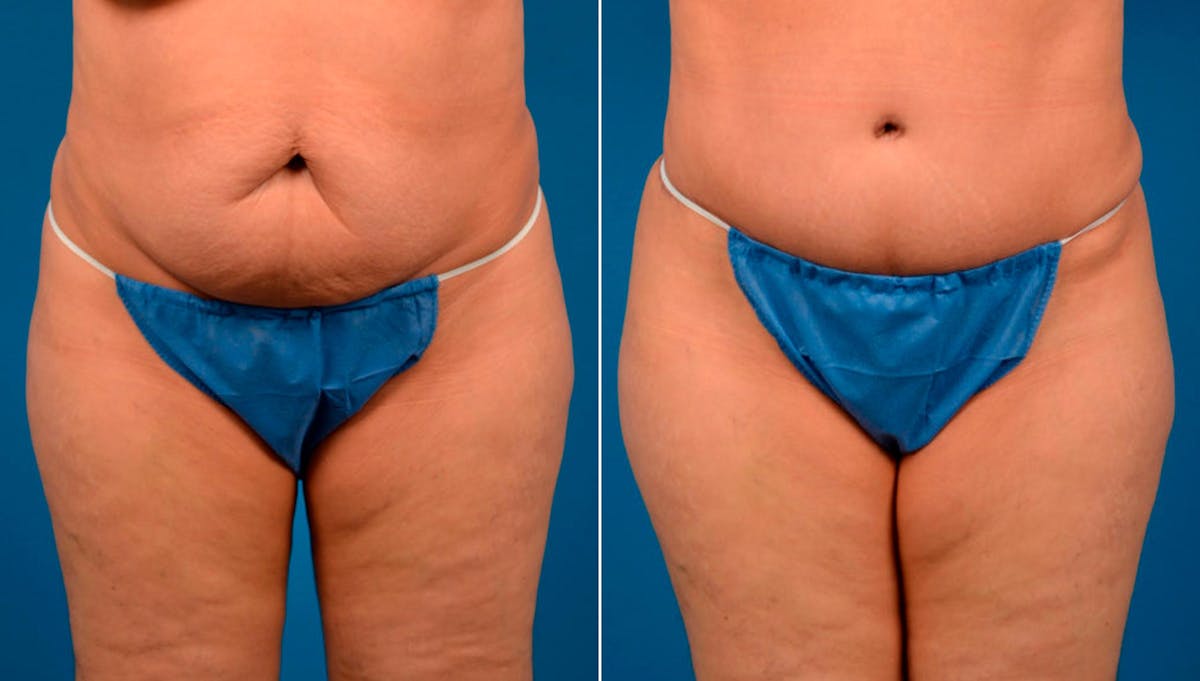 Hidden Tummy Tuck Before & After Gallery - Patient 124954 - Image 1