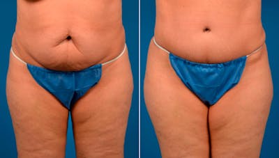 Hidden Tummy Tuck Before & After Gallery - Patient 124954 - Image 1