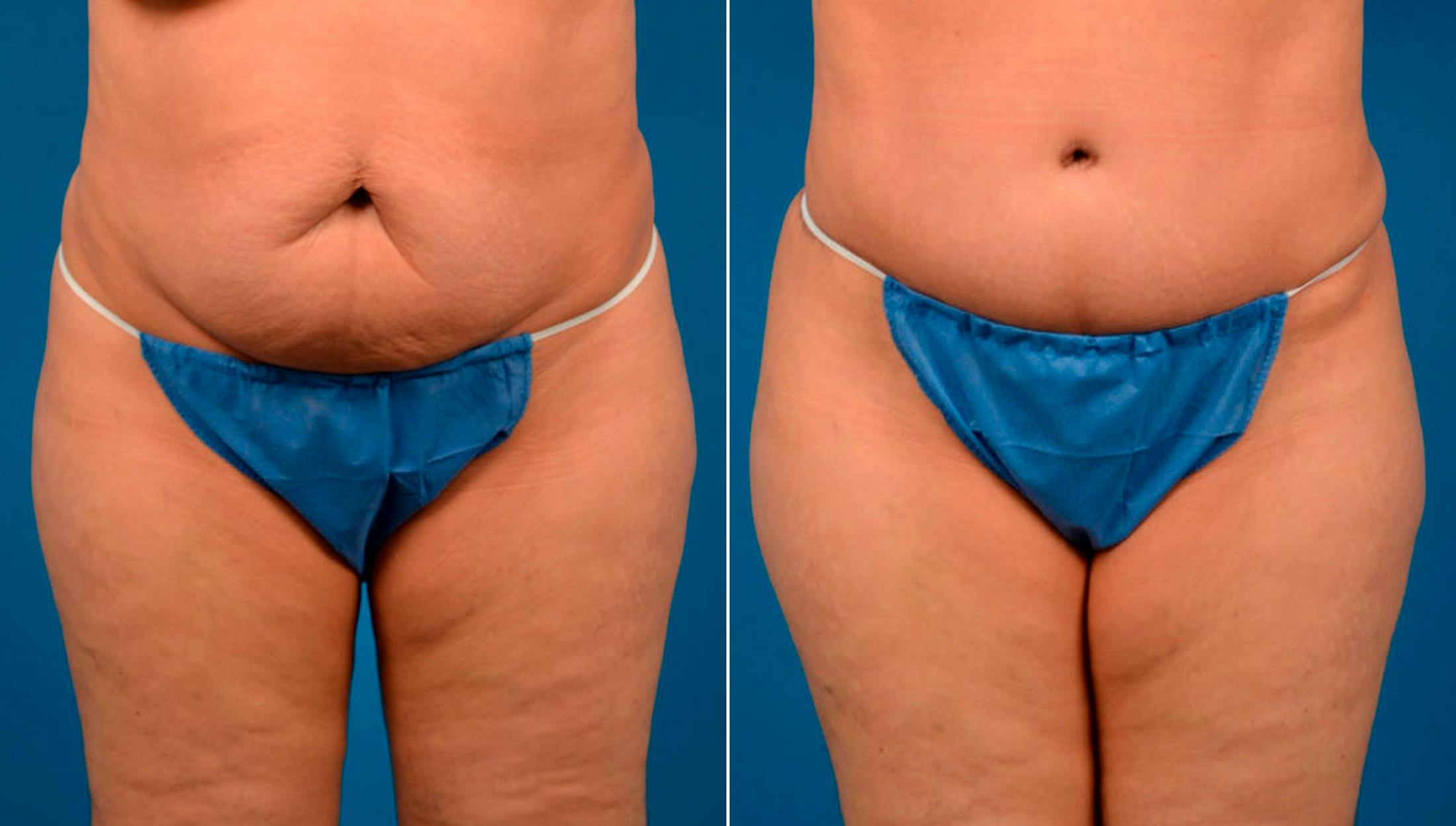 Tummy Tuck Before & After Gallery - Patient 122406746 - Image 1
