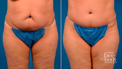 Hidden Tummy Tuck Before & After Gallery - Patient 124954 - Image 1