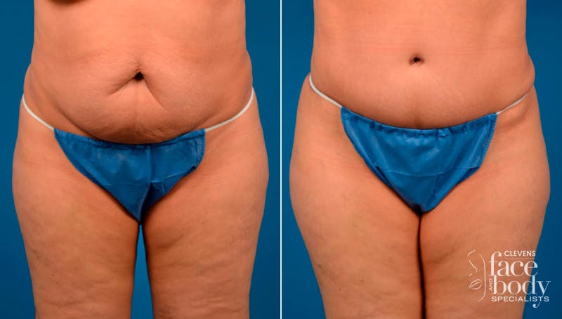 Hidden Tummy Tuck Before & After Gallery - Patient 124954 - Image 1