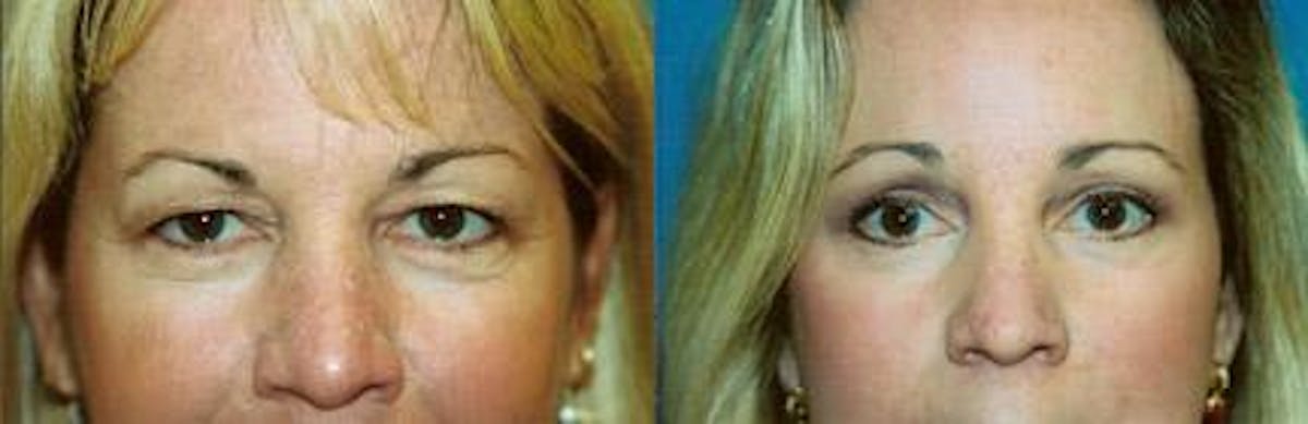 Skin Resurfacing Before & After Gallery - Patient 122406745 - Image 2