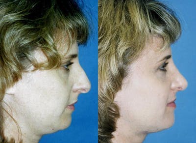 Rhinoplasty Before & After Gallery - Patient 122406744 - Image 1