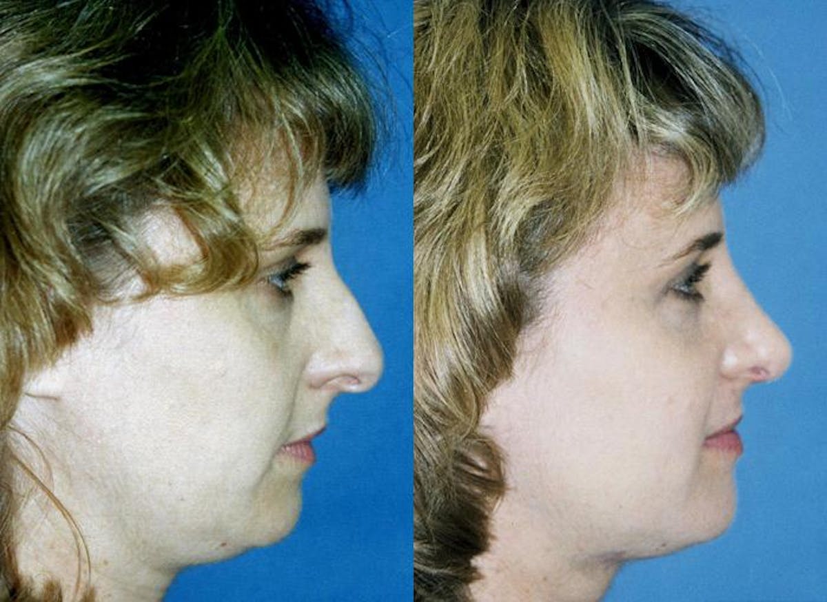 Rhinoplasty Before & After Gallery - Patient 122406744 - Image 1