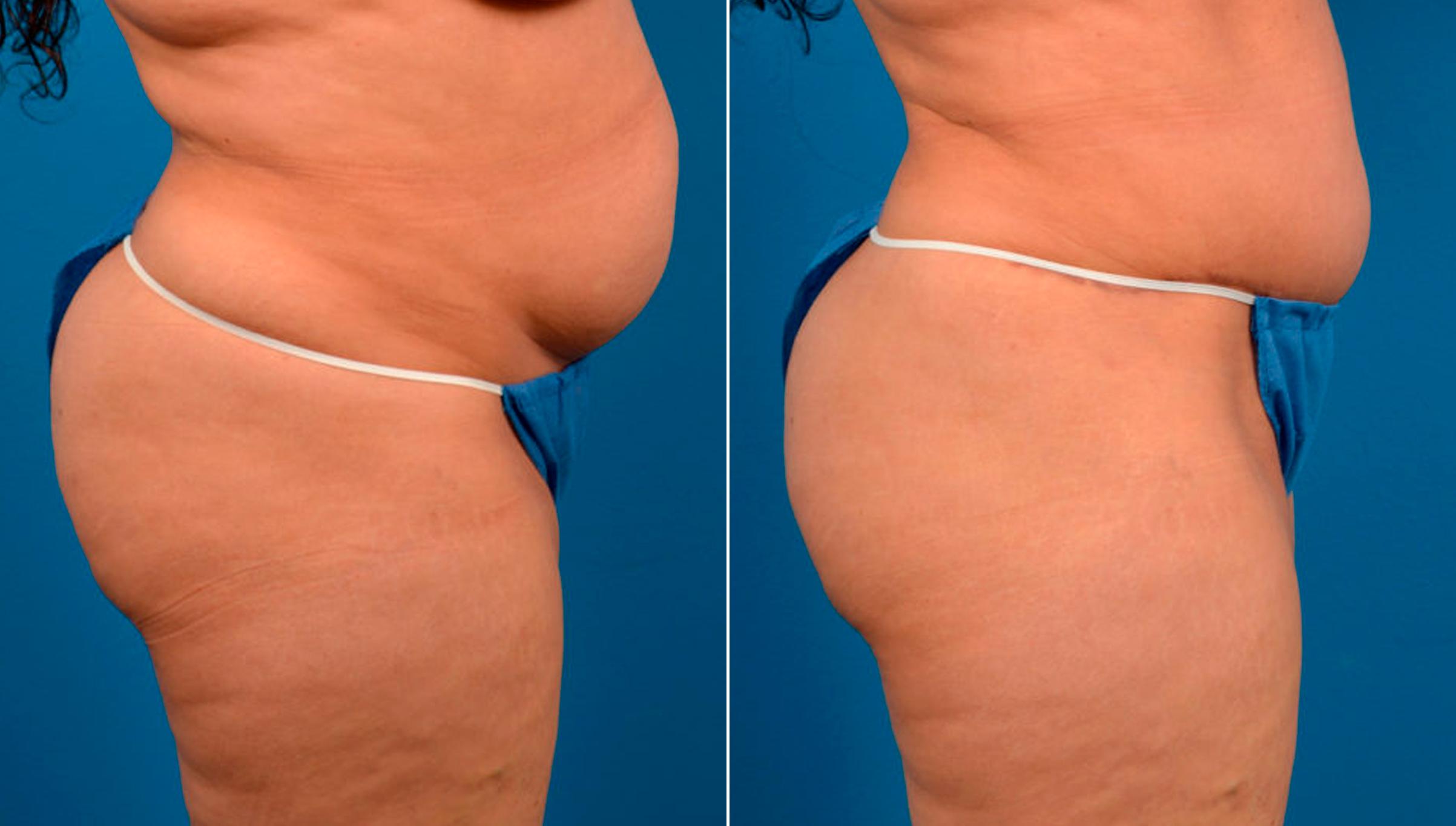 Hidden Tummy Tuck Before & After Gallery - Patient 124954 - Image 2