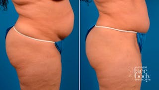 Hidden Tummy Tuck Before & After Gallery - Patient 124954 - Image 2