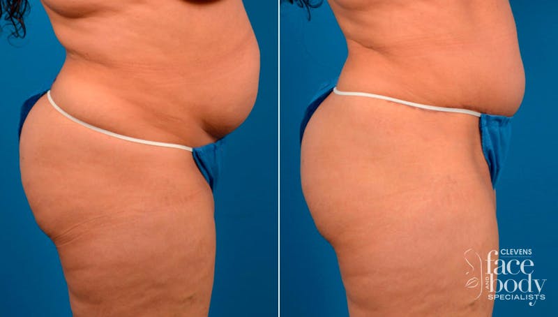 Hidden Tummy Tuck Before & After Gallery - Patient 124954 - Image 2