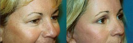 Skin Resurfacing Before & After Gallery - Patient 122406745 - Image 3