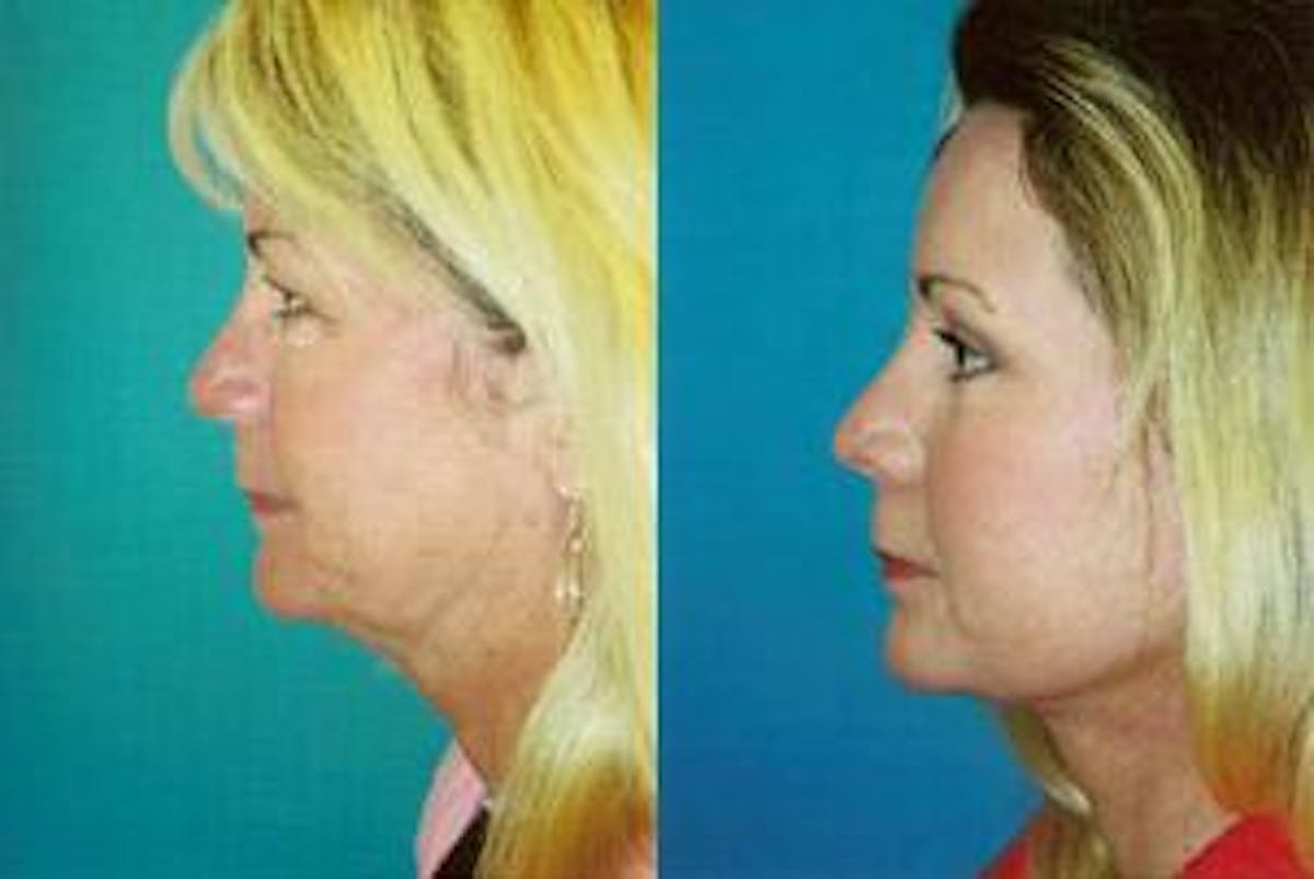 Skin Resurfacing Before & After Gallery - Patient 122406745 - Image 4
