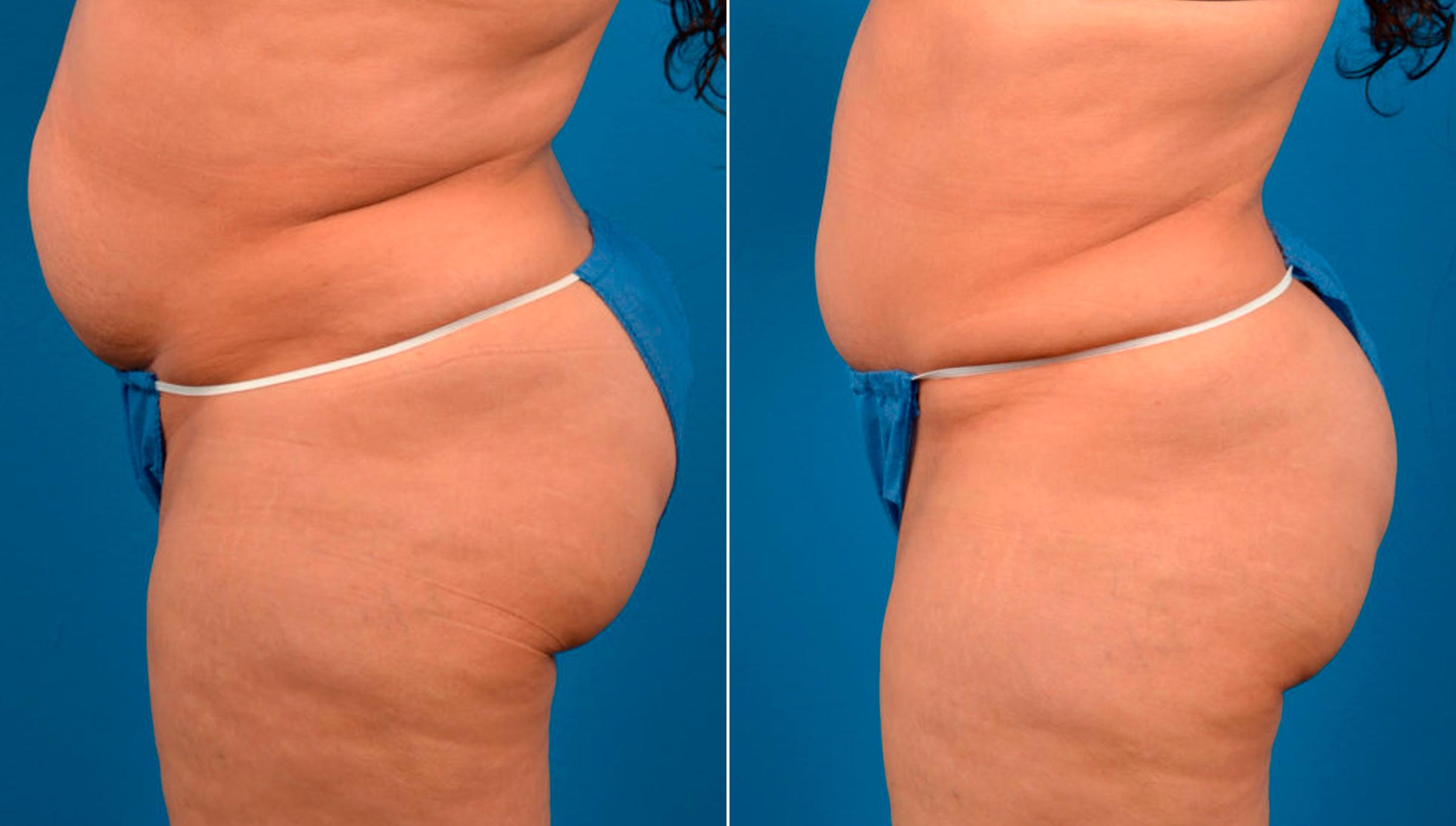 Hidden Tummy Tuck Before & After Gallery - Patient 124954 - Image 3
