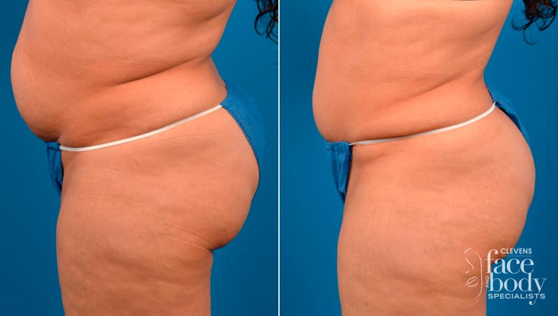 Hidden Tummy Tuck Before & After Gallery - Patient 124954 - Image 3