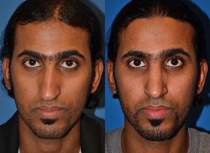Rhinoplasty Before & After Gallery - Patient 122406748 - Image 1