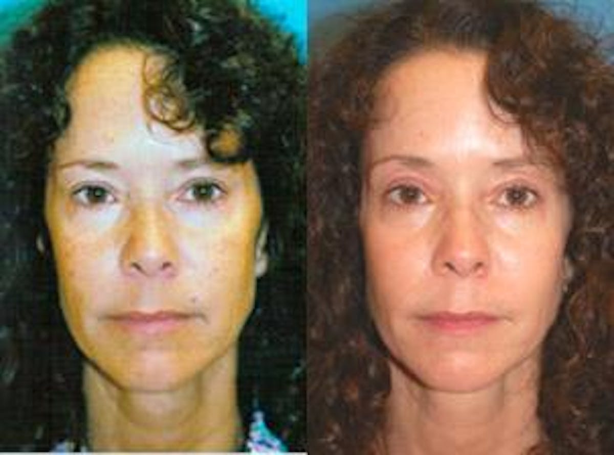 Skin Resurfacing Before & After Gallery - Patient 122406747 - Image 1
