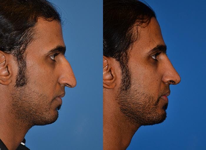 Rhinoplasty Before & After Gallery - Patient 122406748 - Image 2