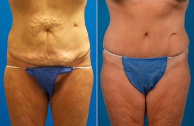 Tummy Tuck Before & After Gallery - Patient 125223 - Image 1
